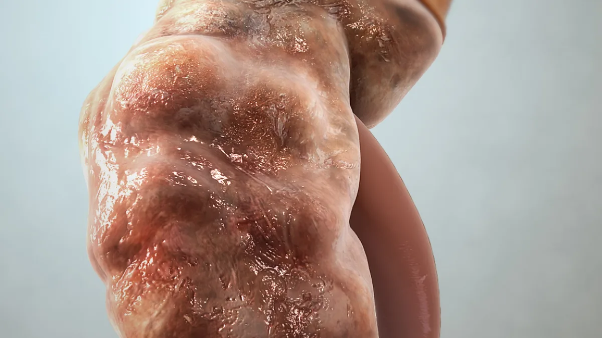 Chronic Kidney Disease