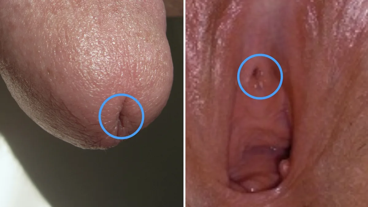 Urinary Blockage